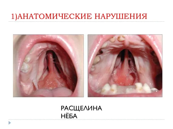 1)АНАТОМИЧЕСКИЕ НАРУШЕНИЯ РАСЩЕЛИНА НЁБА