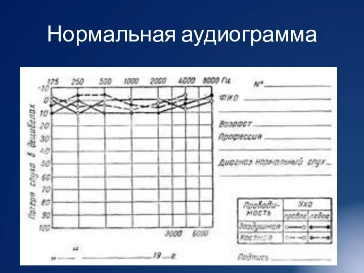 Нормальная аудиограмма