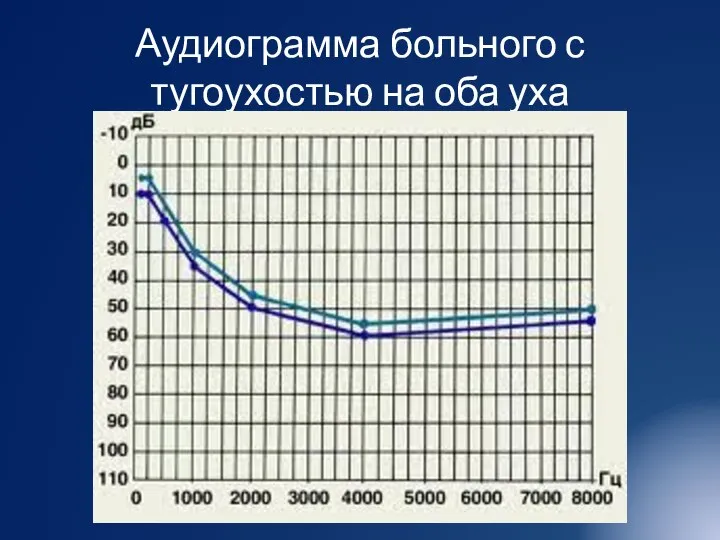 Аудиограмма больного с тугоухостью на оба уха