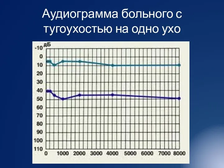 Аудиограмма больного с тугоухостью на одно ухо