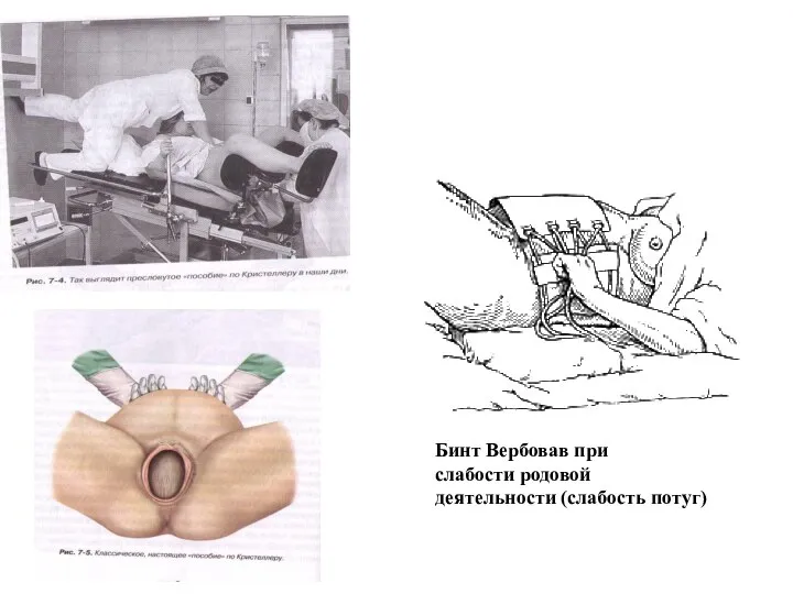 Бинт Вербовав при слабости родовой деятельности (слабость потуг)