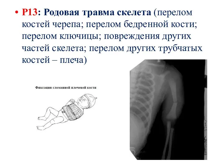 Р13: Родовая травма скелета (перелом костей черепа; перелом бедренной кости; перелом ключицы;