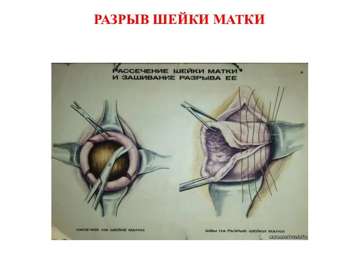 РАЗРЫВ ШЕЙКИ МАТКИ