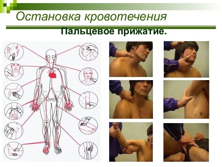 Остановка кровотечения Пальцевое прижатие.