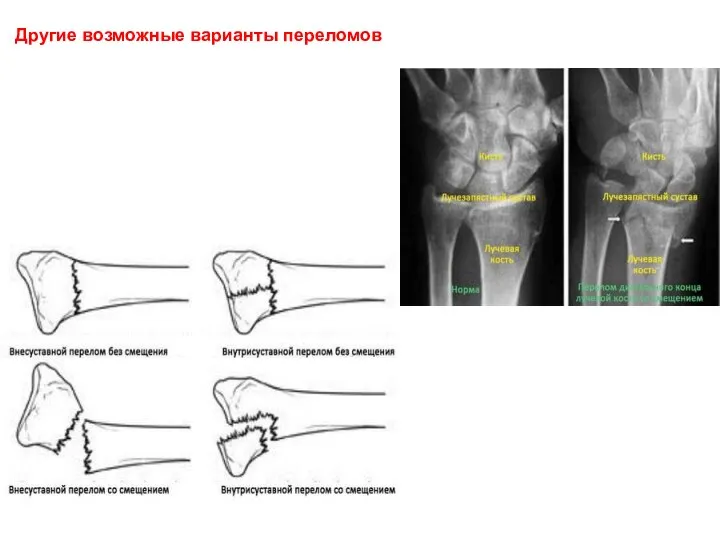 Другие возможные варианты переломов