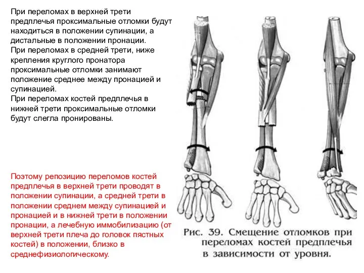 При переломах в верхней трети предплечья проксимальные отломки будут находиться в положении