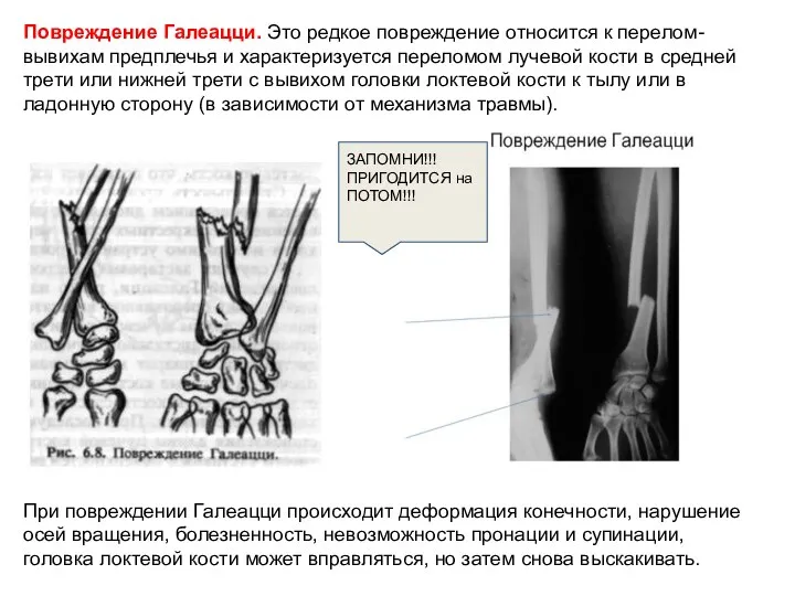 Повреждение Галеацци. Это редкое повреждение относится к перелом-вывихам предплечья и характеризуется переломом