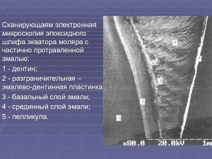 Сканирующаям электронная микроскопия эпоксидного шлифа экватора моляра с частично протравленной эмалью: 1