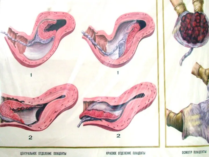 МЕХАНИЗМ ОТДЕЛЕНИЯ ПЛАЦЕНТЫ