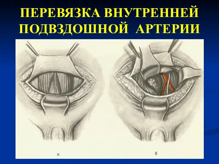 ПЕРЕВЯЗКА ВНУТРЕННЕЙ ПОДВЗДОШНОЙ АРТЕРИИ