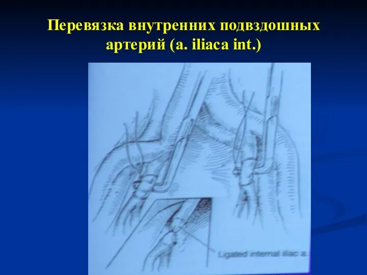 Перевязка внутренних подвздошных артерий (а. iliaca int.)