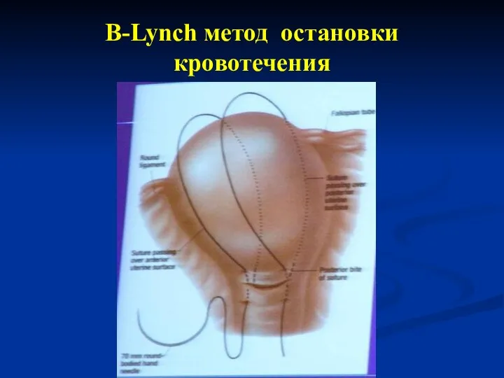 B-Lynch метод остановки кровотечения