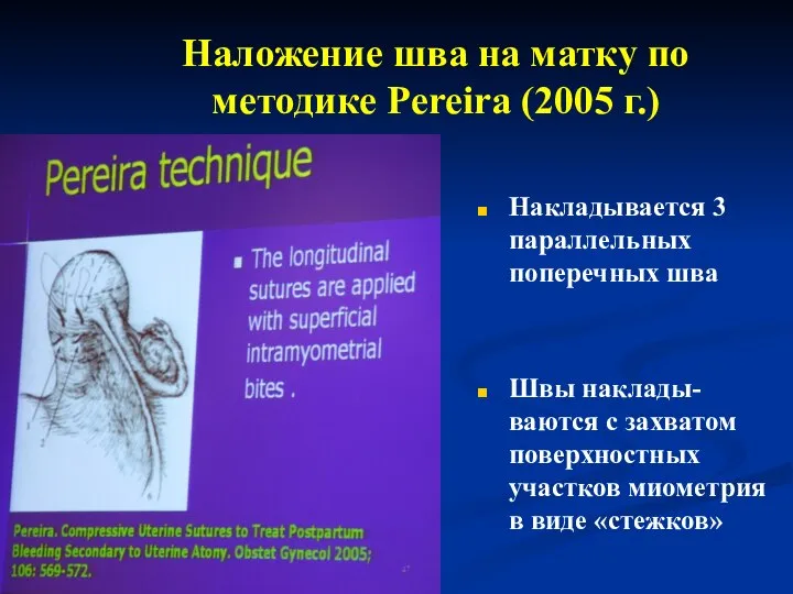 Наложение шва на матку по методике Pereira (2005 г.) Накладывается 3 параллельных