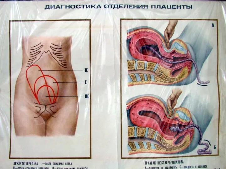 ПРИЗНАКИ ОТДЕЛЕНИЯ ПЛАЦЕНТЫ