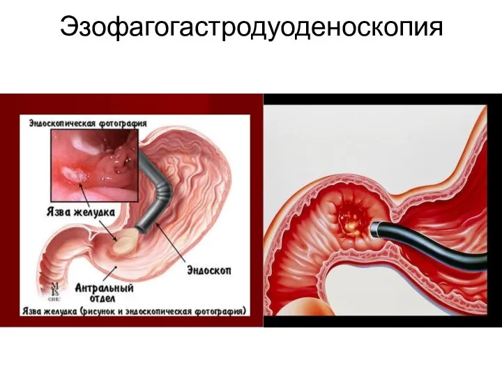 Эзофагогастродуоденоскопия