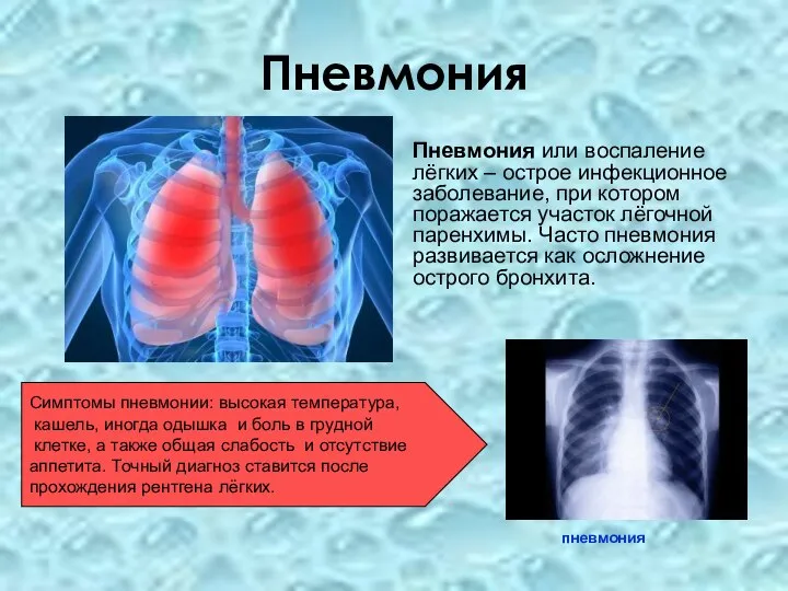 Пневмония Пневмония или воспаление лёгких – острое инфекционное заболевание, при котором поражается
