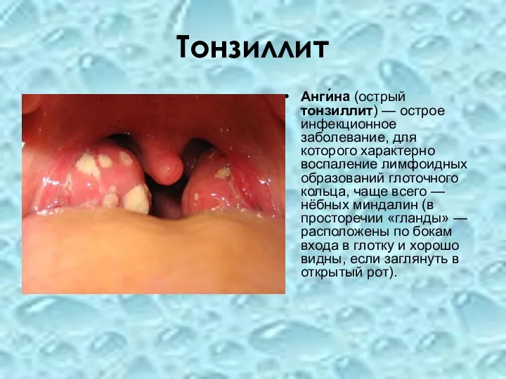 Тонзиллит Анги́на (острый тонзиллит) — острое инфекционное заболевание, для которого характерно воспаление