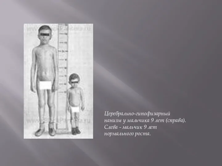 Церебрально-гипофизарный нанизм у мальчика 9 лет (справа). Слева - мальчик 9 лет нормального роста.