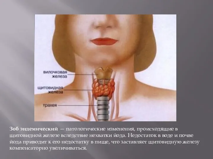 Зоб эндемический — патологические изменения, происходящие в щитовидной железе вследствие нехватки йода.