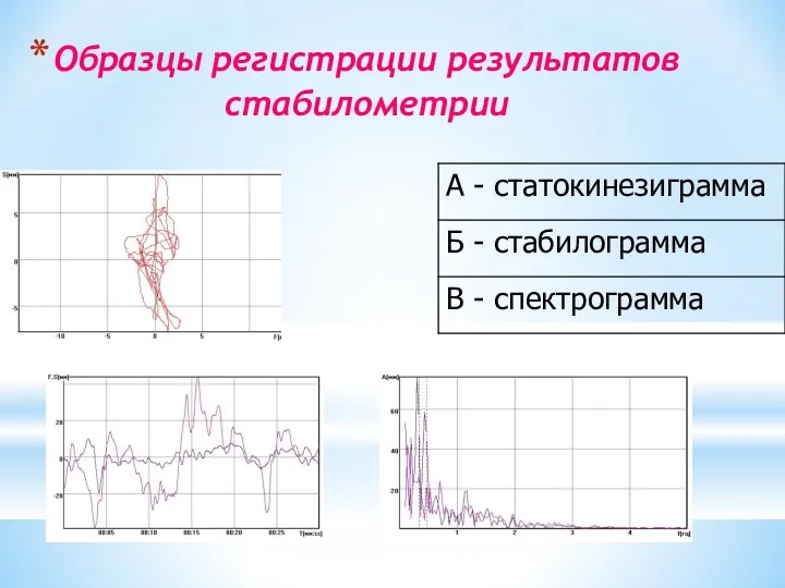 Образцы регистрации результатов стабилометрии