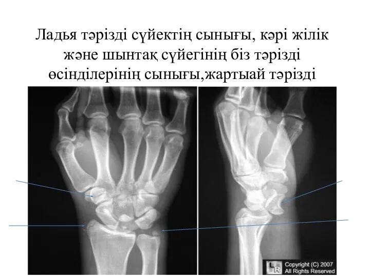 Ладья тәрізді сүйектің сынығы, кәрі жілік және шынтақ сүйегінің біз тәрізді өсінділерінің сынығы,жартыай тәрізді сүйектің шығуымен