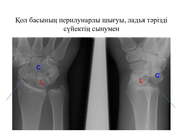 Қол басының перилунарлы шығуы, ладья тәрізді сүйектің сынумен