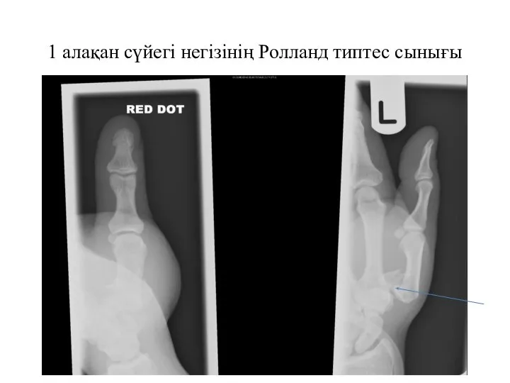 1 алақан сүйегі негізінің Ролланд типтес сынығы