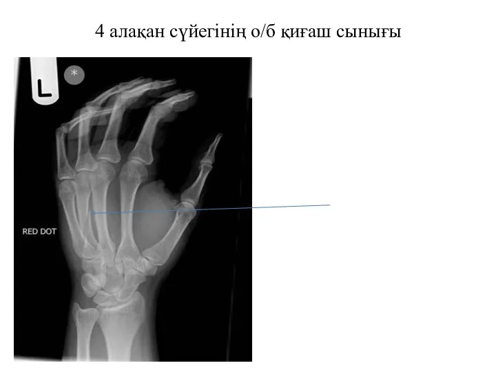 4 алақан сүйегінің о/б қиғаш сынығы