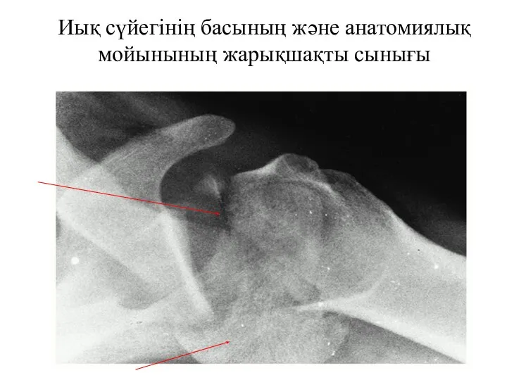 Иық сүйегінің басының және анатомиялық мойынының жарықшақты сынығы