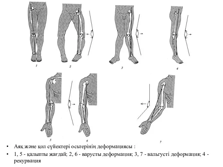 Аяқ және қол сүйектері осьтерінің деформациясы : 1, 5 - қалыпты жағдай;