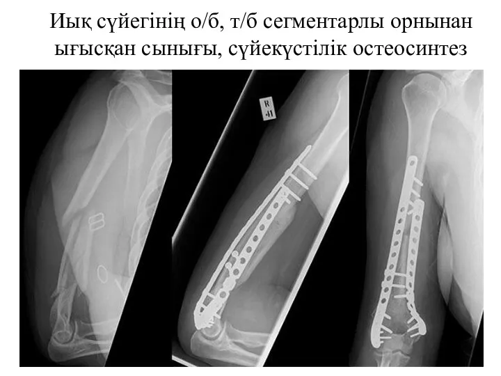 Иық сүйегінің о/б, т/б сегментарлы орнынан ығысқан сынығы, сүйекүстілік остеосинтез