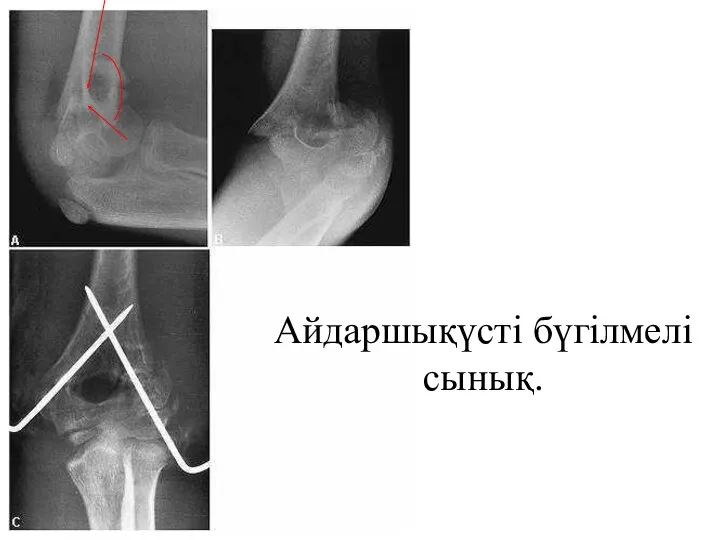 Айдаршықүсті бүгілмелі сынық.