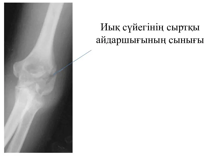 Иық сүйегінің сыртқы айдаршығының сынығы