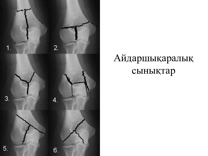 Айдаршықаралық сынықтар