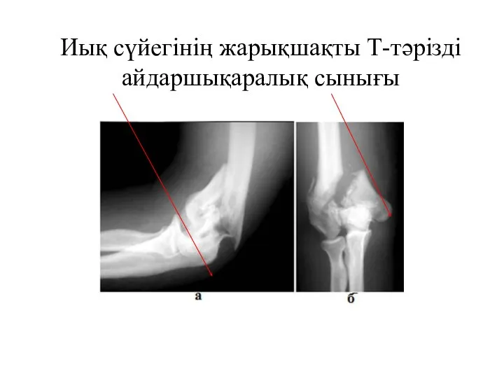 Иық сүйегінің жарықшақты Т-тәрізді айдаршықаралық сынығы