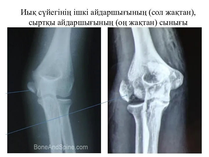 Иық сүйегінің ішкі айдаршығының (сол жақтан), сыртқы айдаршығының (оң жақтан) сынығы