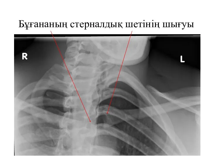 Бұғананың стерналдық шетінің шығуы