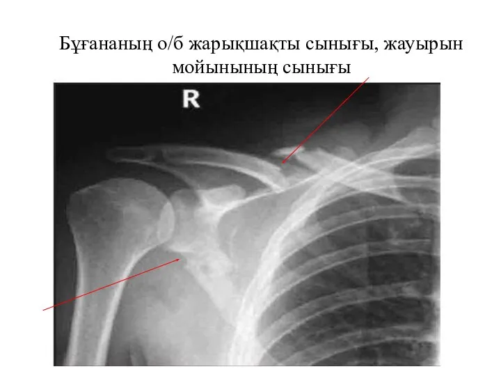 Бұғананың о/б жарықшақты сынығы, жауырын мойынының сынығы