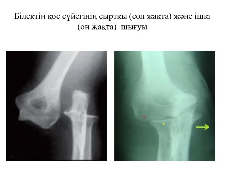 Білектің қос сүйегінің сыртқы (сол жақта) және ішкі (оң жақта) шығуы