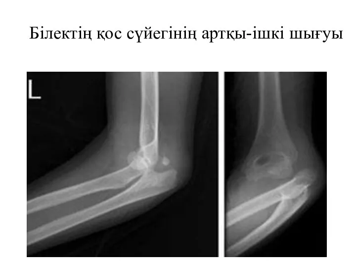 Білектің қос сүйегінің артқы-ішкі шығуы