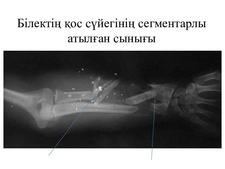 Білектің қос сүйегінің сегментарлы атылған сынығы