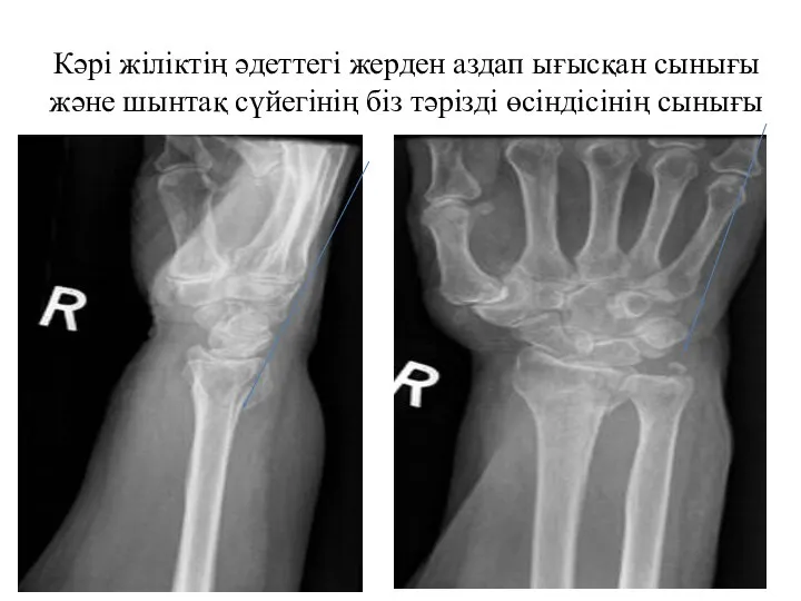 Кәрі жіліктің әдеттегі жерден аздап ығысқан сынығы және шынтақ сүйегінің біз тәрізді өсіндісінің сынығы