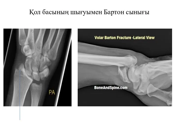 Қол басының шығуымен Бартон сынығы