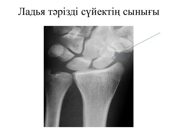 Ладья тәрізді сүйектің сынығы