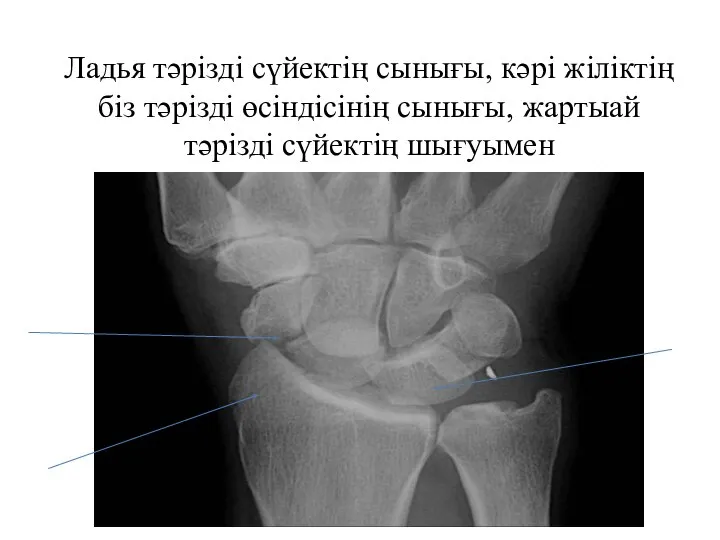 Ладья тәрізді сүйектің сынығы, кәрі жіліктің біз тәрізді өсіндісінің сынығы, жартыай тәрізді сүйектің шығуымен