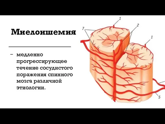 Миелоишемия медленно прогрессирующее течение сосудистого поражения спинного мозга различной этиологии.