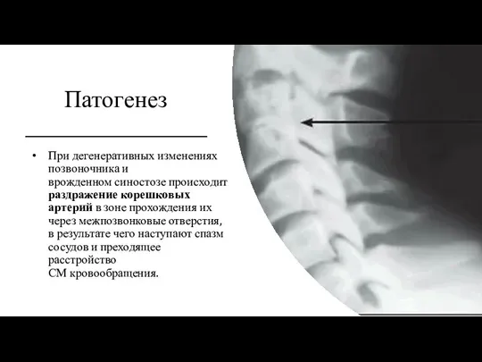 Патогенез При дегенеративных изменениях позвоночника и врожденном синостозе происходит раздражение корешковых артерий