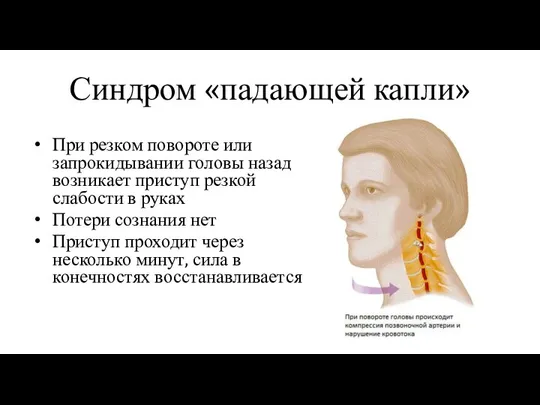 Синдром «падающей капли» При резком повороте или запрокидывании головы назад возникает приступ