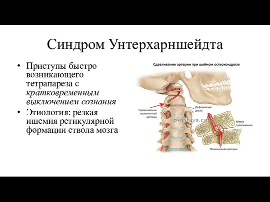 Синдром Унтерхарншейдта Приступы быстро возникающего тетрапареза с кратковременным выключением сознания Этиология: резкая