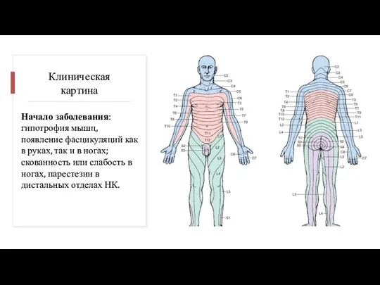 Клиническая картина Начало заболевания: гипотрофия мышц, появление фасцикуляций как в руках, так